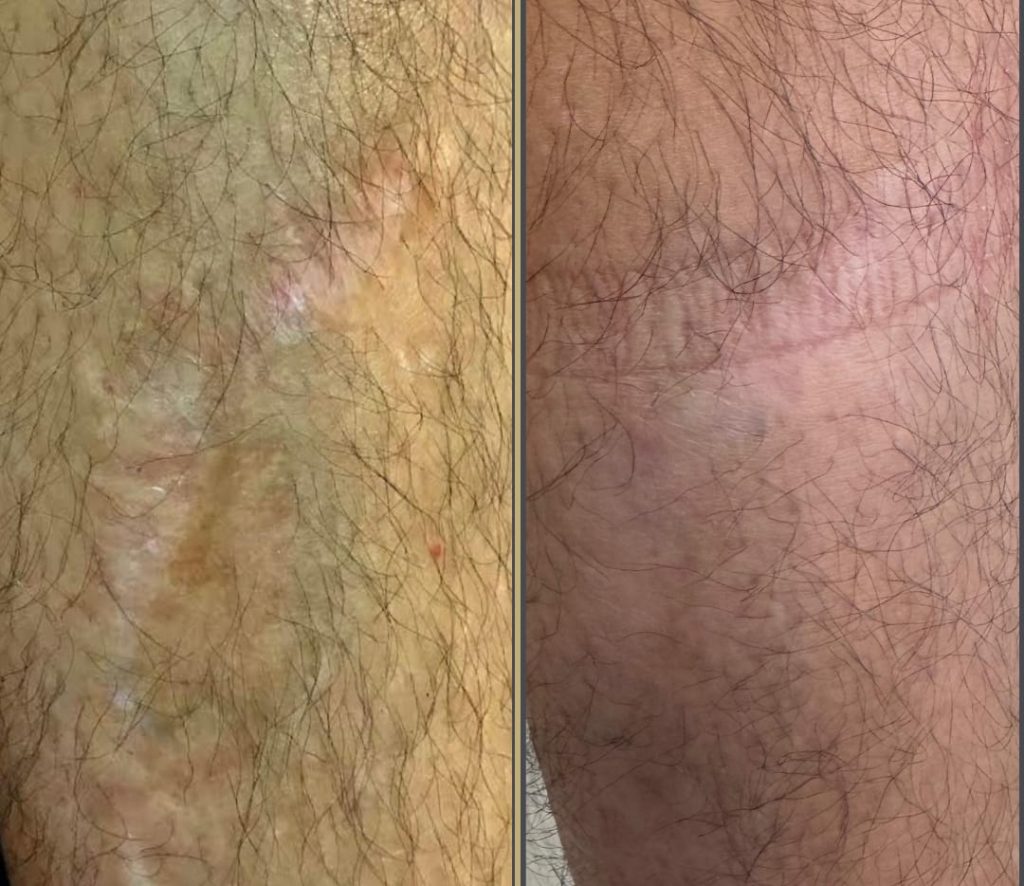 tratamientos-para-cicatrices