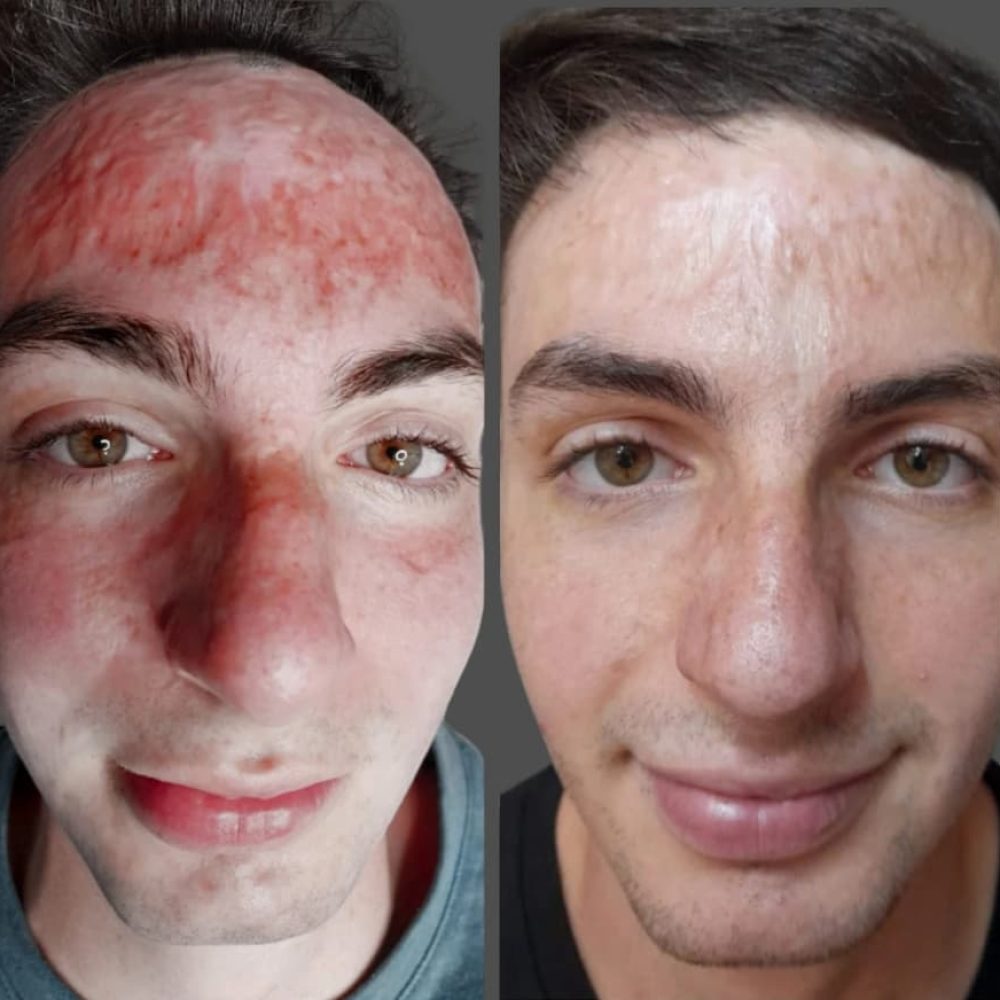 Antes_y_despues_quemadura